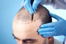 تفاوت کاشت مو در خانم‌ها و آقایان؛ تکنیک‌ها و چالش‌های متفاوت