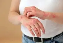 دلیل مهم اگزما در پوست
