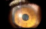 فیلم> یک کرم داخل قرنیه چشم زن هندی
