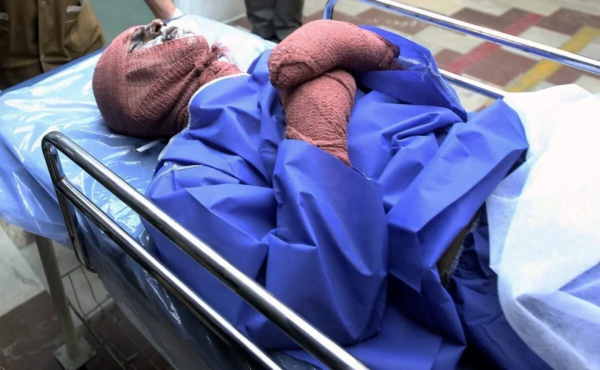 اسیدپاشی عجیب روی مرد جوان و دختر ۱۱ ساله‌اش