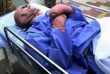 اسیدپاشی عجیب روی مرد جوان و دختر ۱۱ ساله‌اش