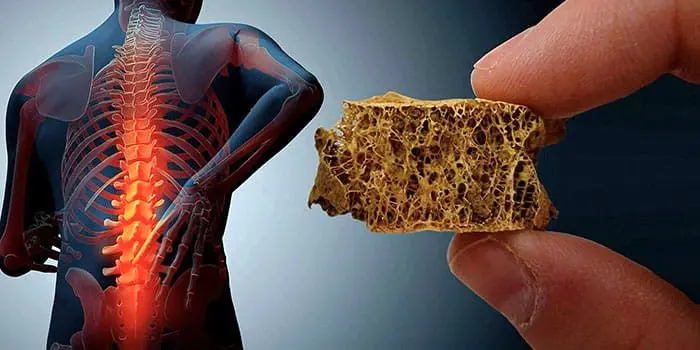 پوکی استخوان سونامی خاموش سلامت در دوران سالمندی