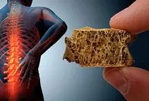 پوکی استخوان سونامی خاموش سلامت در دوران سالمندی