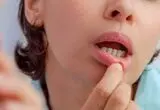 زخم‌های دردناک دهان از کجا می‌آیند؟/ دلایل شایع و راه‌های کاهش درد و پیشگیری