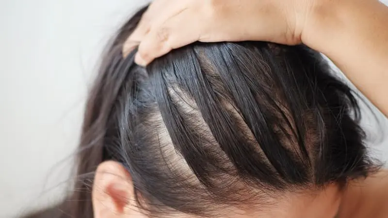 یک حقیقت هولناک؛ تنها کمی استرس کافی است تا ریزش مو آغاز شود