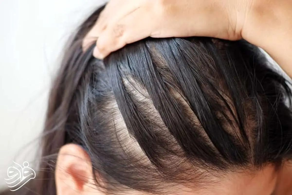 یک حقیقت هولناک؛ تنها کمی استرس کافی است تا ریزش مو آغاز شود