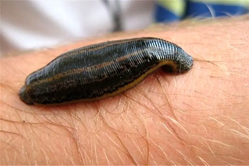 زالو درمانی، روشی کم‌هزینه و مؤثر برای کنترل پسوریازیس