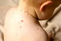 زنگ خطر «سرخک» در شمال کشور