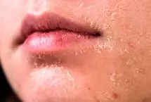 کمبود این ویتامین‌ها و خشکی پوست صورت 
