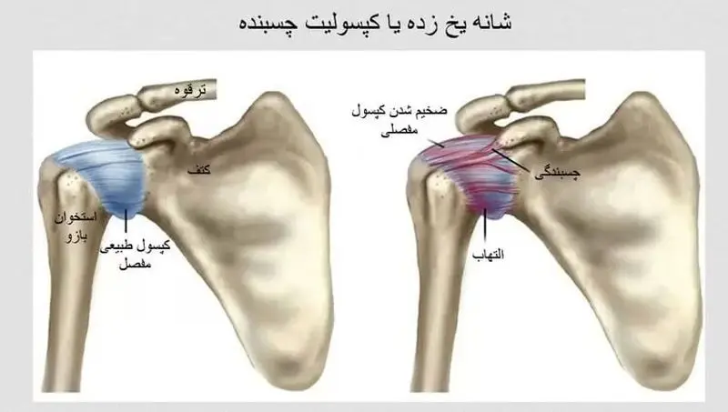 شانه یخ زده
