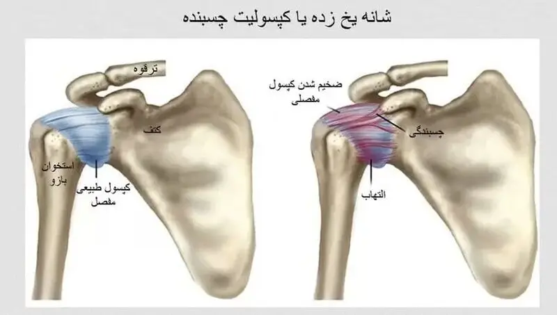 شانه یخ زده