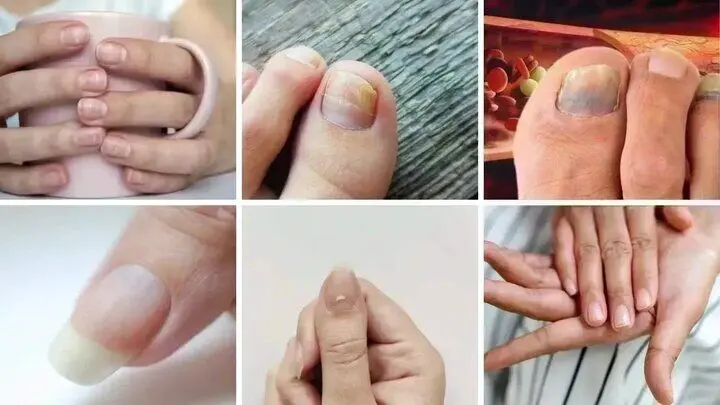 ۷ نشانه هشداردهنده کلسترول بالا که روی ناخن‌ها ظاهر می‌شوند