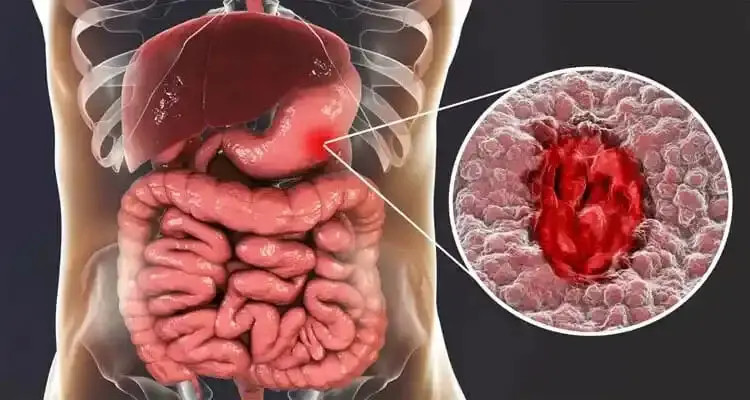 این داروها دومین علت شایع زخم معده هستند