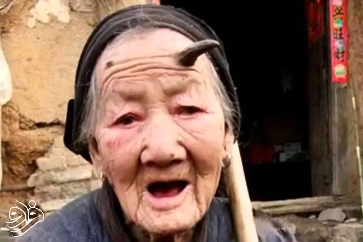 چرا بعضی انسان‌ها «شاخ» درمی‌آورند؟