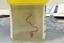 خارج کردن کرم ۱۸ سانتی‌متری از مغز یک مرد