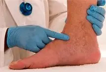 علایم اولیه واریس