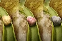 سنگ کیسه صفرا چطور ایجاد می‌شود؟