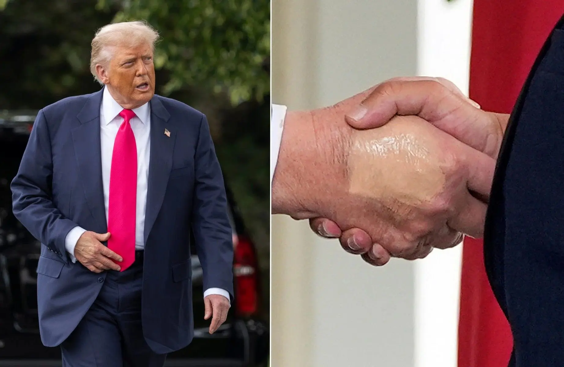کاخ سفید چسب زخم روی دست ترامپ را به دست‌دادن‌های زیاد نسبت داد