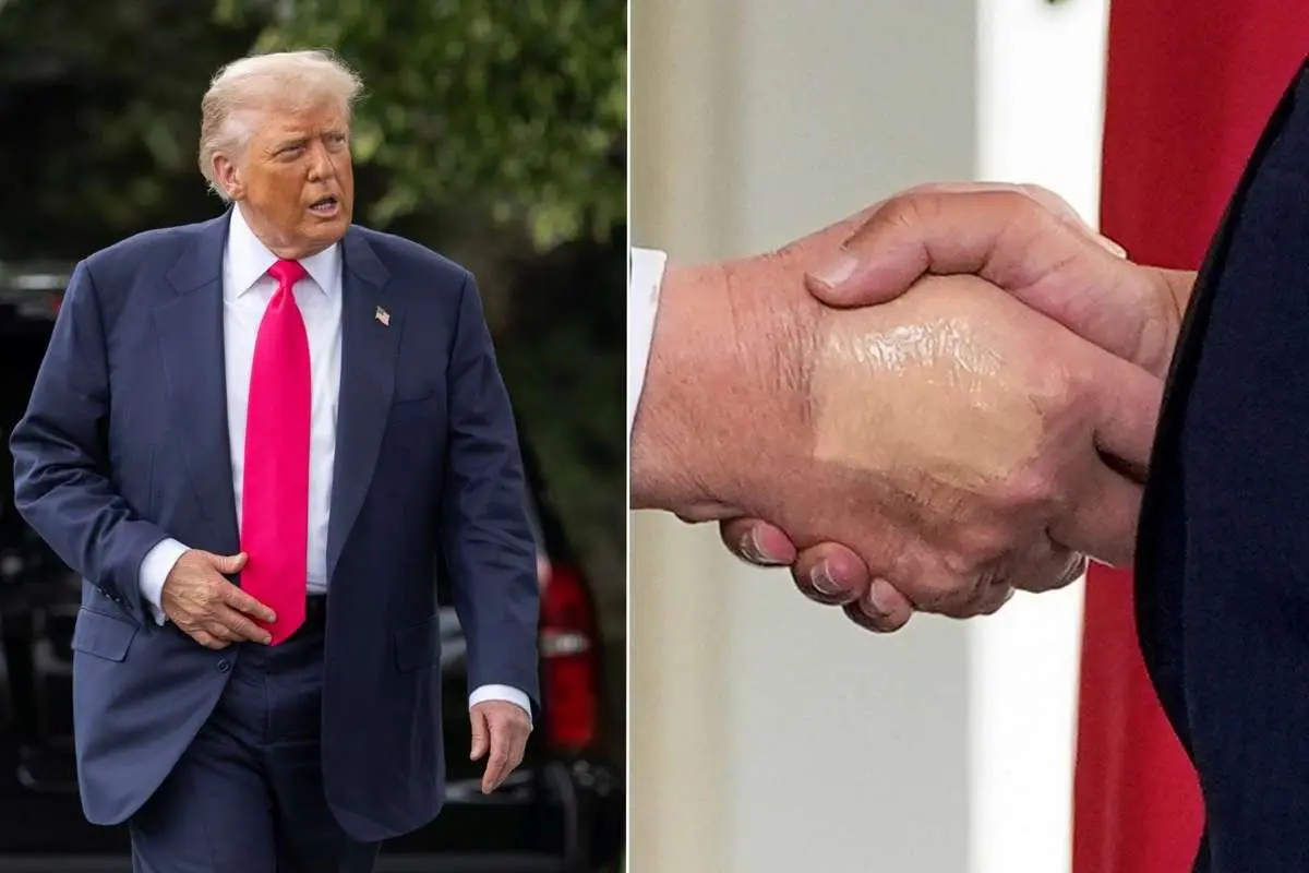 کاخ سفید چسب زخم روی دست ترامپ را به دست‌دادن‌های زیاد نسبت داد