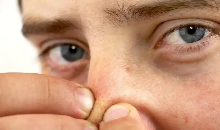 دلیل جوش روی بینی و روش های درمان