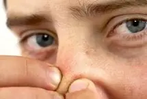 دلیل جوش روی بینی و روش های درمان