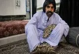 مرد درختی برای درمان راهی آمریکا شد