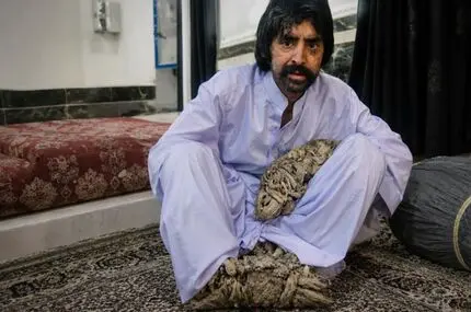 مرد درختی برای درمان راهی آمریکا شد