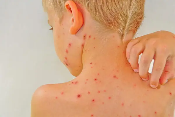 آنچه والدین باید درباره آبله‌مرغان و زونا بدانند