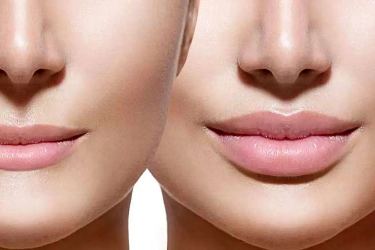 تزریق ژل یا فیلر؟ تفاوتها، کاربردها و انتخاب درست برای شما