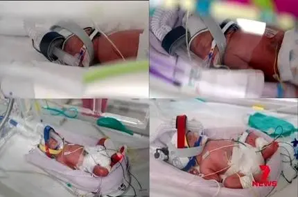 تولد نادر چهارقلوهای کاملاً همسان؛ رخدادی با احتمال یک در ۱۵ میلیون
