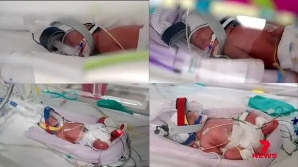 تولد نادر چهارقلوهای کاملاً همسان؛ رخدادی با احتمال یک در ۱۵ میلیون