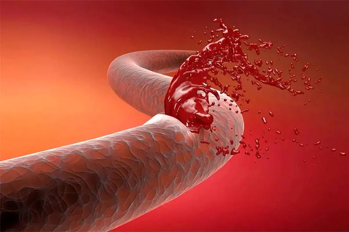 اقدامات فوری برای کنترل خونریزی هنگام جنگ