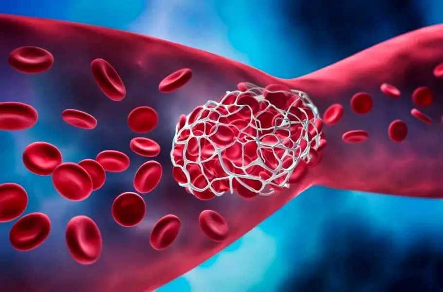  معمای لخته‌های خونی ناشی از واکسن کرونا حل شد