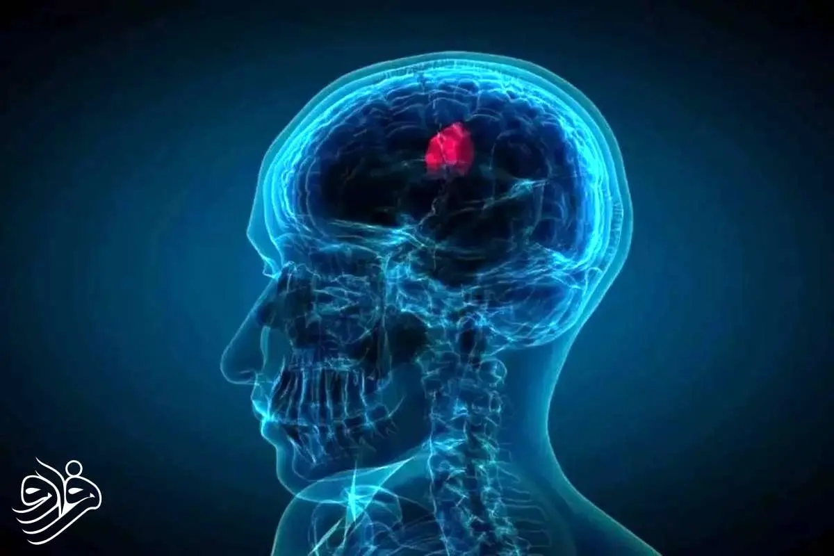 قطره‌ بینی که تومورهای کشنده مغز را کوچک می‌کند