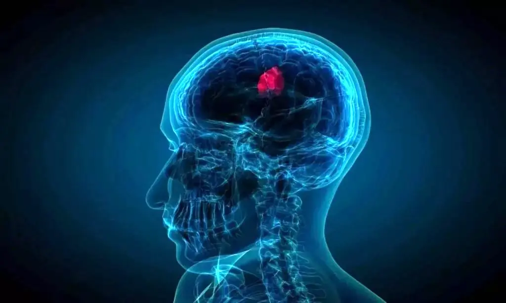 قطره‌ بینی که تومورهای کشنده مغز را کوچک می‌کند