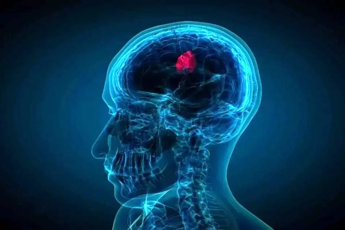 این نشانه‌ها را جدی بگیرید / 7 علامت هشداردهنده تومور مغزی