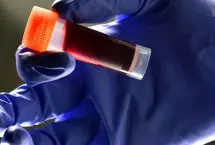 گروه خونی که بیشتر از همه سکته مغزی می‌کند!