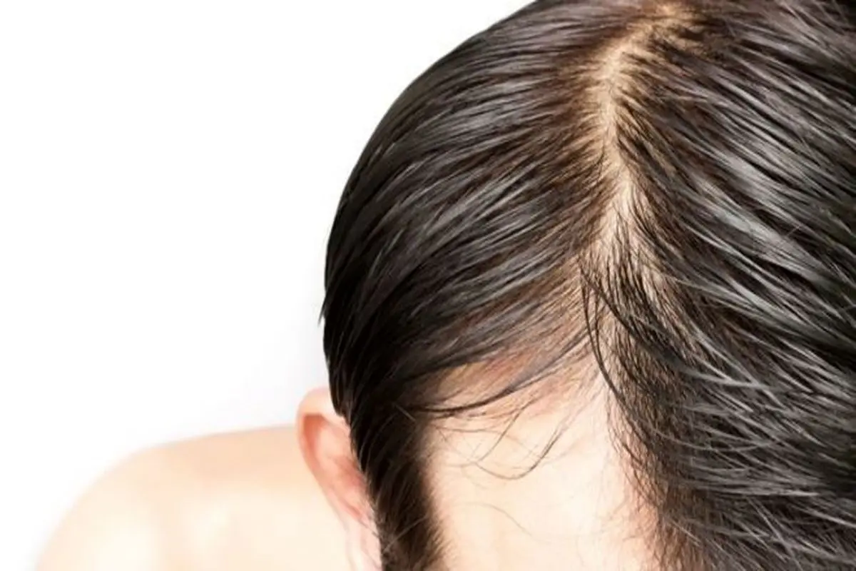 علت چرب شدن سریع موها چیست؟