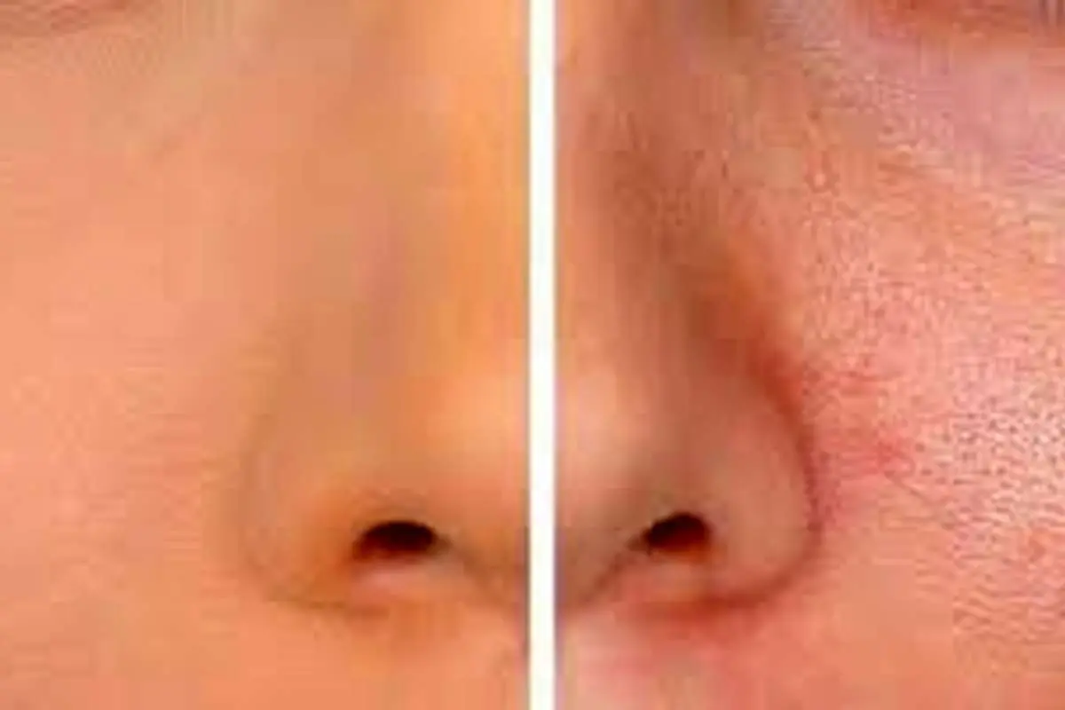 با منافذ باز پوست چه کنیم؟