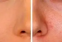 با منافذ باز پوست چه کنیم؟
