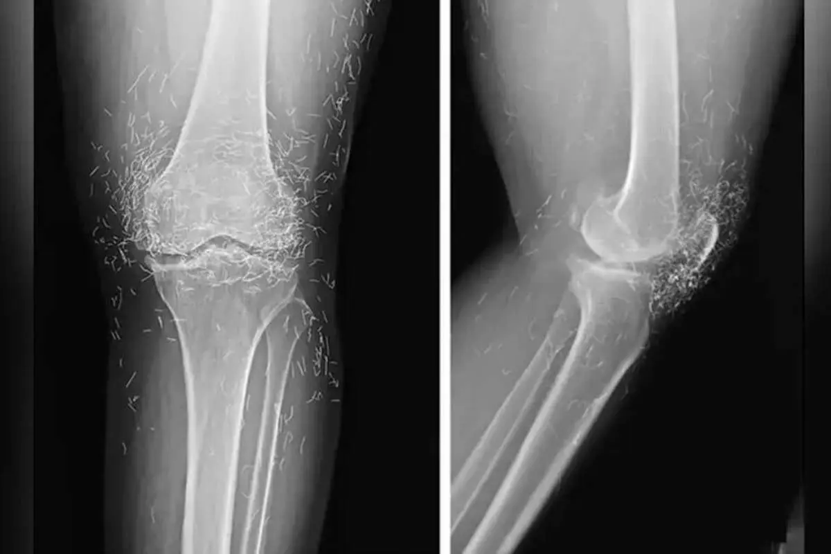 کشف صدها رشته طلای خالص در زانوی زن مبتلا به آرتروز