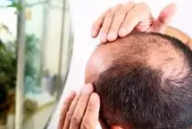 کشف تصادفی درمان طاسی